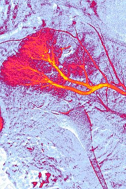 Buerger's Disease