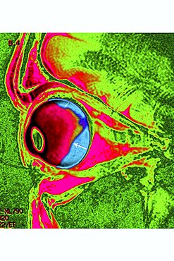 Retinal Detachment