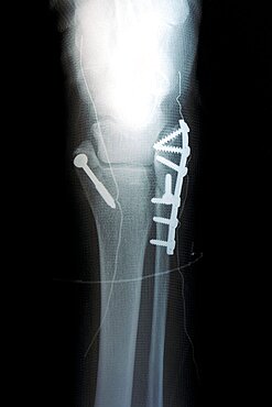 Ankle Osteosynthesis, X-Ray