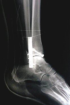 Ankle Osteosynthesis, X-Ray