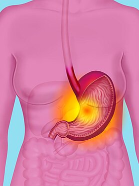 Gastric Ulcer, Illustration