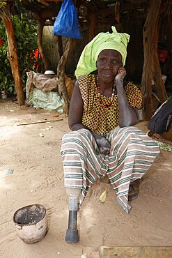 Villager with Leprosy