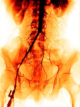 Arterial Thrombosis