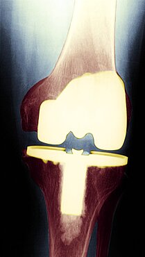 Knee Prosthesis,  X-Ray