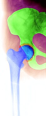 Hip Osteoarthritis, X-Ray