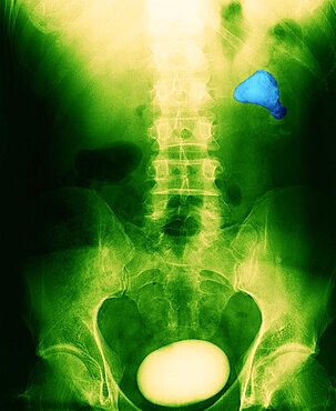 Renal Lithiasis, X-Ray