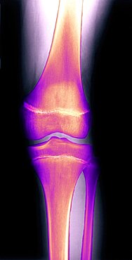 Colorized X-ray image of knee