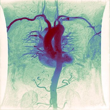 Angiographic image of human heart