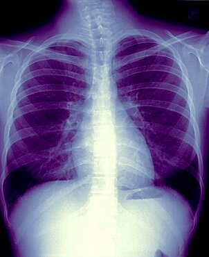 Lungs, X-Ray