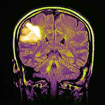 Brain scan with lymphoma