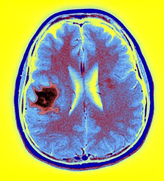 Brain scan with lymphoma