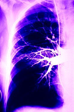 Pulmonary Embolism, X-Ray