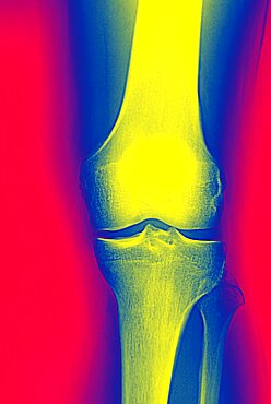 Knee, X-Ray