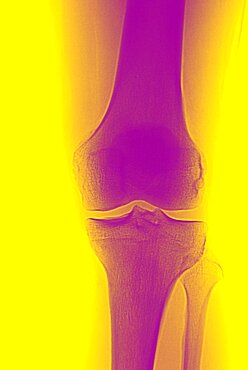 Knee, X-Ray