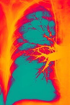 Pulmonary Embolism, X-Ray