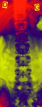 Spinal Column, X-Ray