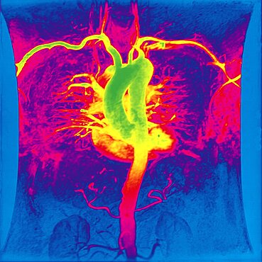 Aorta, Angiography