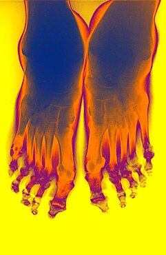 Rheumatoid Arthritis, X-Ray