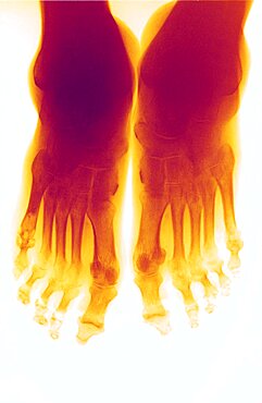 Rheumatoid Arthritis, X-Ray