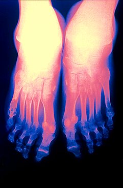 Rheumatoid Arthritis, X-Ray