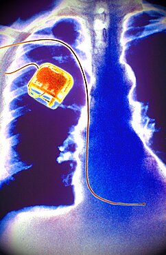 X-Ray Showing Pacemaker
