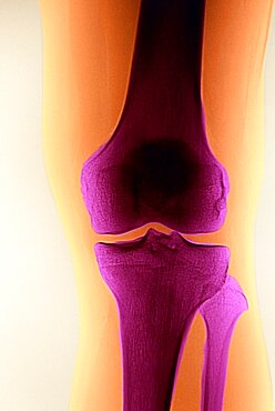 Knee, X-Ray