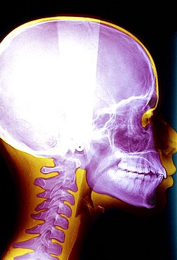 X Ray Of Head