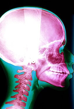 X Ray Of Head