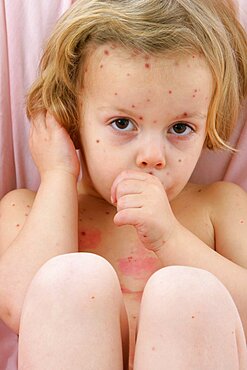 Child with Chickenpox And Friend Without