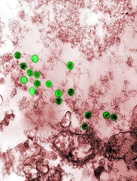 Epstein-Barr Virus, TEM