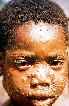 Monkeypox Maculopapular Rash