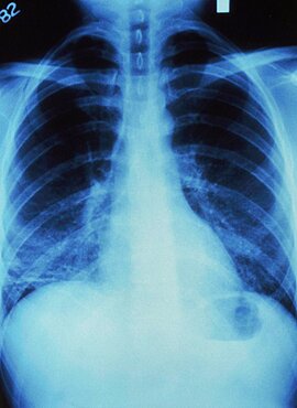 Pulmonary Pneumocystosis, X-ray