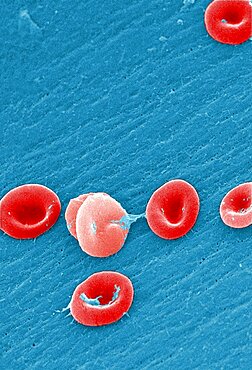 Sickle Cell Anemia, Human RBCs, SEM