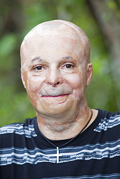 Grazi Lisciotto who was horribly burned in a house fire and who now work for the Peter Hughes Burn Foundation providing counselling and support for the victims of bush fires, Australia, Pacific